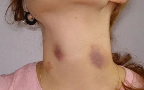 Thực trạng máu loãng khó đông hiện nay