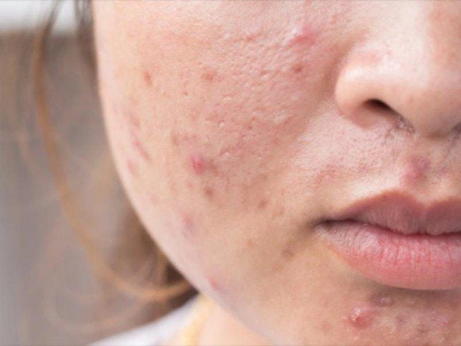 Lưu ý khi điều trị mụn trứng cá mủ ở mặt