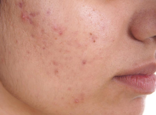 Khám phá lý do mụn trứng cá ở má khó trị