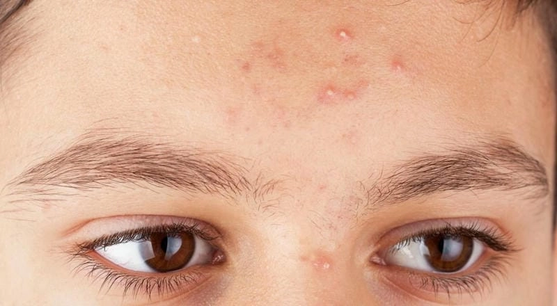 Chân thực với ảnh người bị bệnh mụn trứng cá