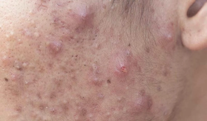 Khắc phục tình trạng da bị mụn trứng cá hiệu quả