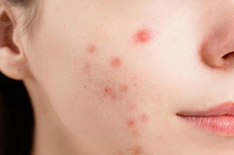 Giải pháp cho mụn trứng cá tuổi dậy thì hiệu quả