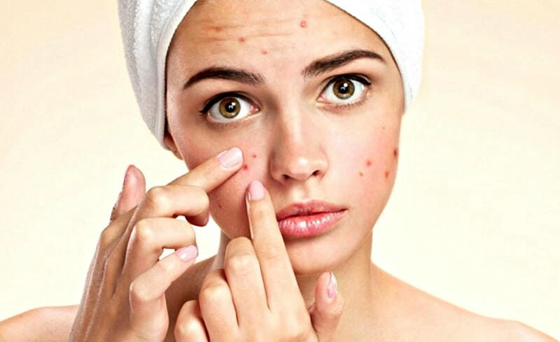 Điều trị kịp thời mụn trứng cá nặng lâu ngày
