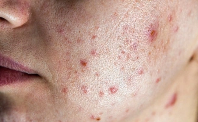 Cách chăm sóc da bị mụn trứng cá nội tiết an toàn