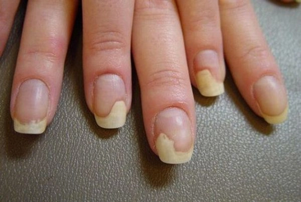 Hình ảnh nấm da tay thường kèm theo ngứa và tróc vảy