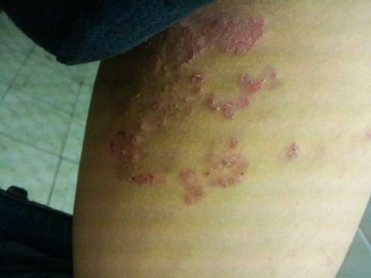 Tìm hiểu kỹ hình ảnh nấm da toàn thân để tránh lây lan