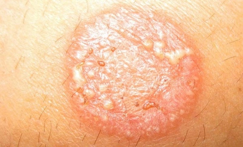 Tổng hợp chi tiết hình ảnh bệnh nấm mèo ở người và vật nuôi