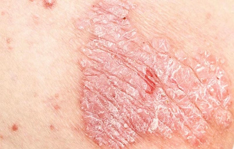 Lưu ý dấu hiệu qua hình ảnh bệnh nấm bìu ở nam giới