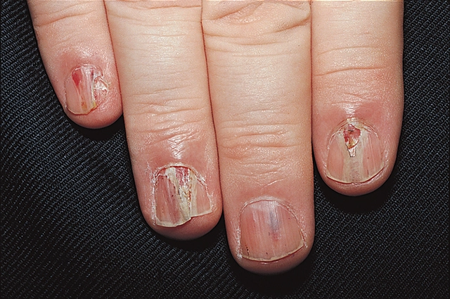 Khám phá biểu hiện qua hình ảnh nấm móng tay thường thấy