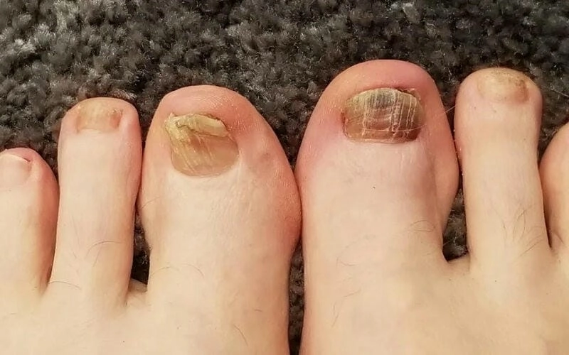 Tìm hiểu qua hình ảnh nấm móng chân ở người lớn và trẻ nhỏ