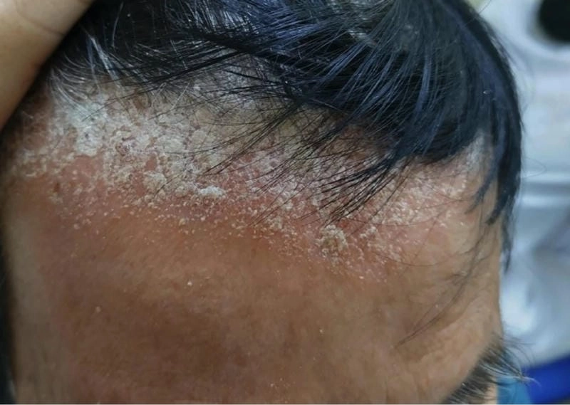 Hình ảnh da đầu bị nấm cho thấy mảng gàu dày và rụng tóc