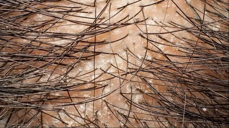 Nấm da đầu hình ảnh thường thấy ở trẻ nhỏ và người nhiều mồ hôi