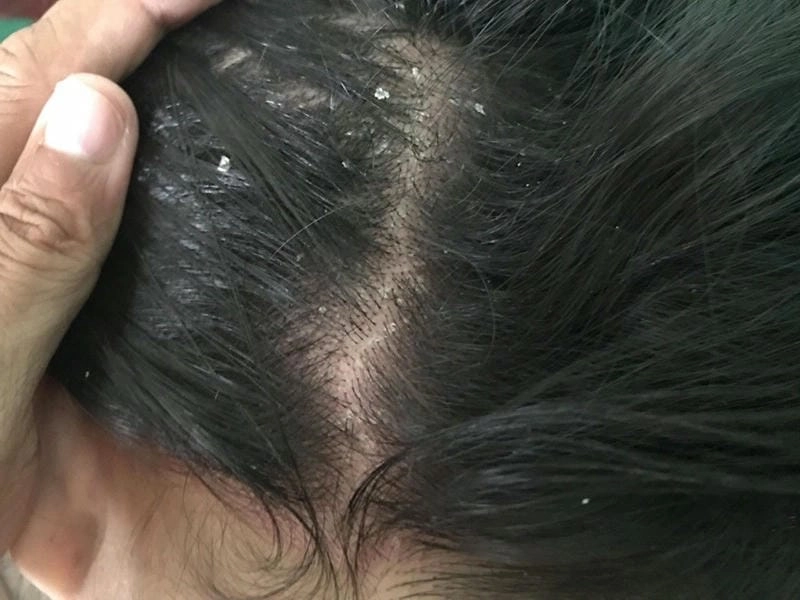 Ảnh nấm đầu ghi lại rõ vùng da tróc vảy và mất tóc cục bộ