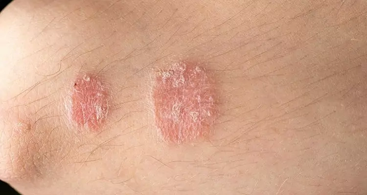 Tổng quan các hình ảnh bệnh nấm phổ biến dễ bị bỏ qua