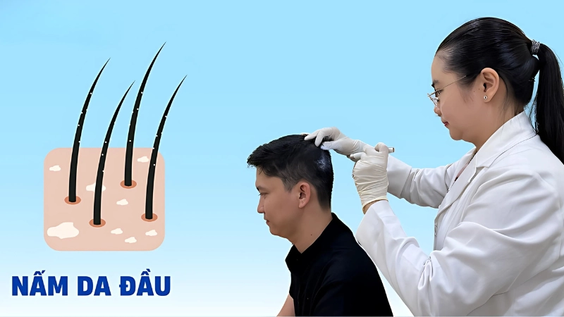Hình ảnh bệnh nấm da đầu chi tiết theo từng giai đoạn