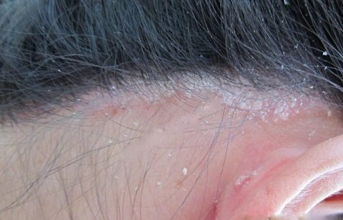 Tổng hợp triệu chứng từ nấm da đầu hình ảnh thực tế