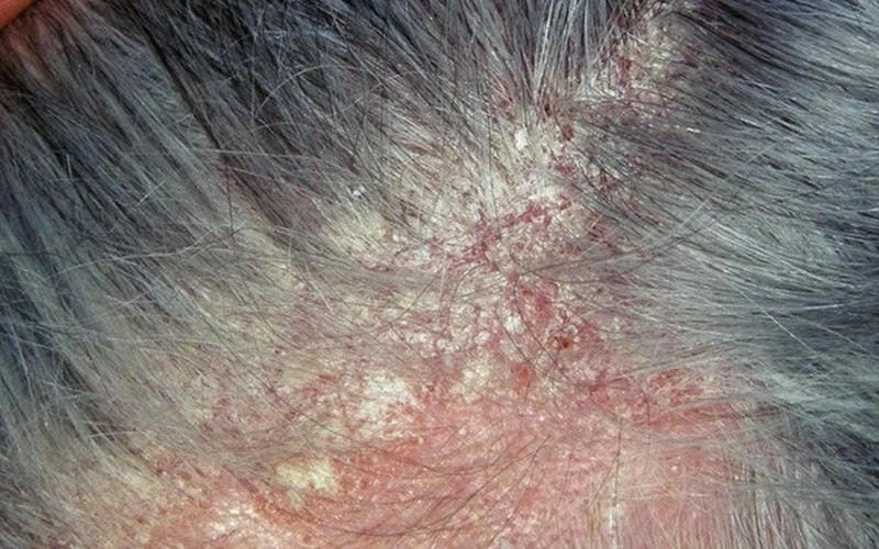 Xem ngay tổng hợp nấm da đầu hình ảnh thực tế