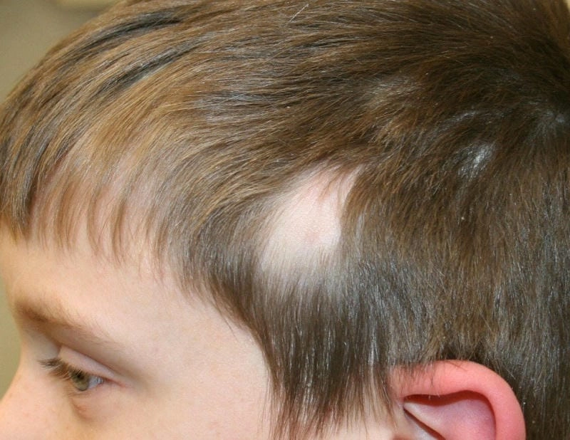 Nhận biết sớm qua hình ảnh bị nấm da đầu