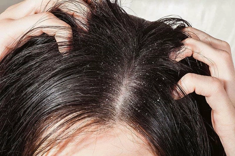 Đừng chủ quan với hình ảnh nấm da đầu điển hình