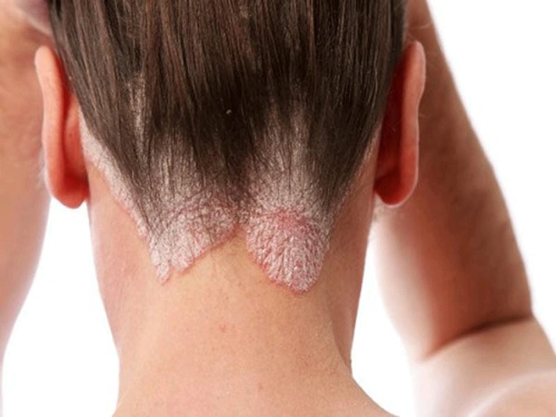 Cẩn trọng với hình ảnh da đầu bị nấm tái phát