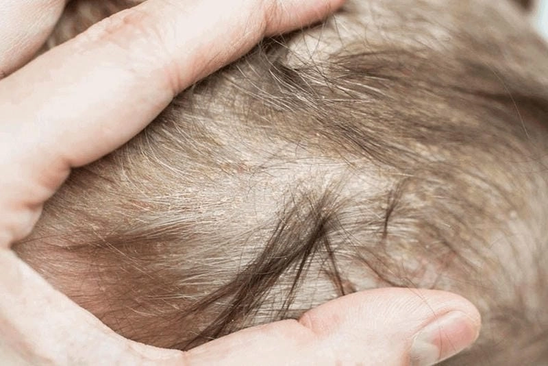 Phân biệt rõ giữa nấm da đầu và gàu