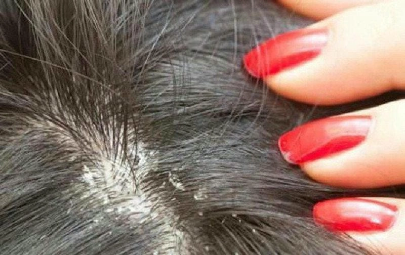 Nhận biết dấu hiệu qua ảnh nấm da đầu rõ nét