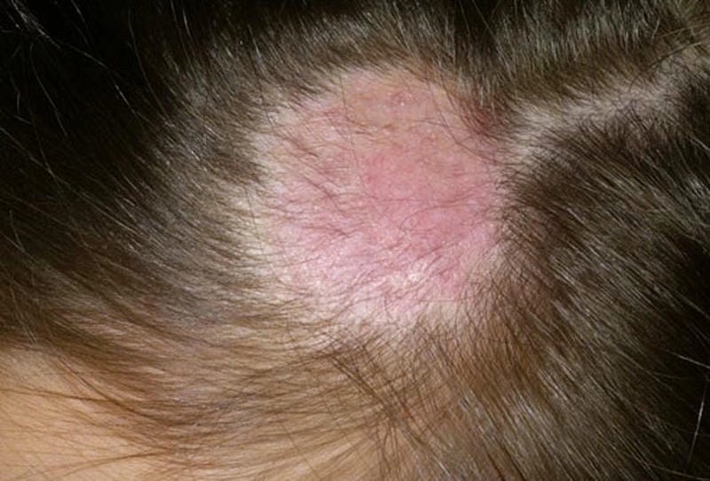 Đừng bỏ qua dấu hiệu qua ảnh nấm da đầu