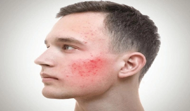 Cảnh báo qua ảnh người bị bệnh nấm da mặt chi tiết