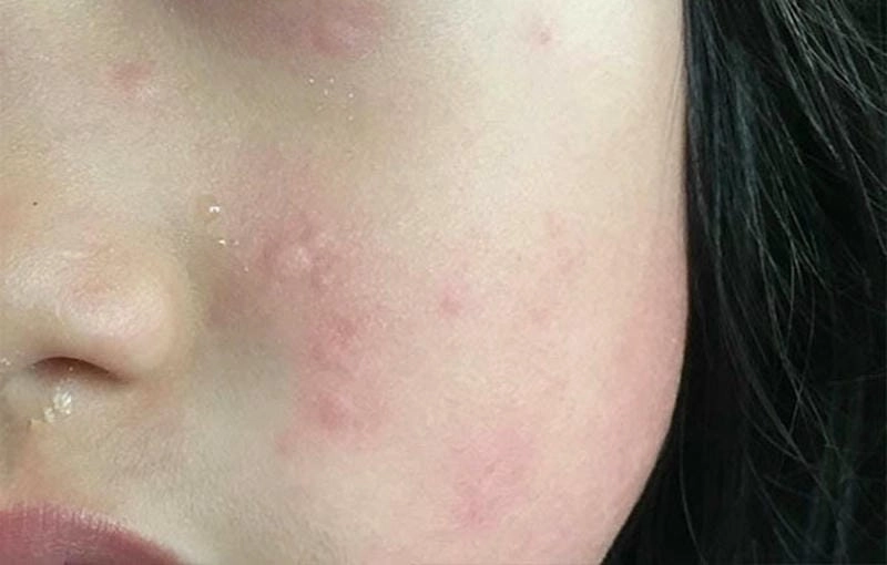 Cách phòng tránh lây lan nấm da mặt hiệu quả