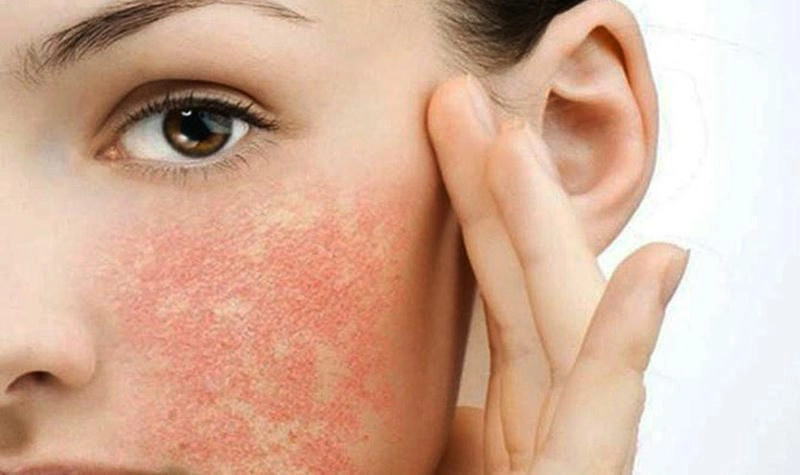 Tìm hiểu nguyên nhân chính gây nấm da mặt thường gặp