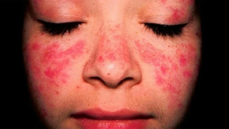 Kinh nghiệm dân gian về cách trị nấm da mặt tại nhà nhanh