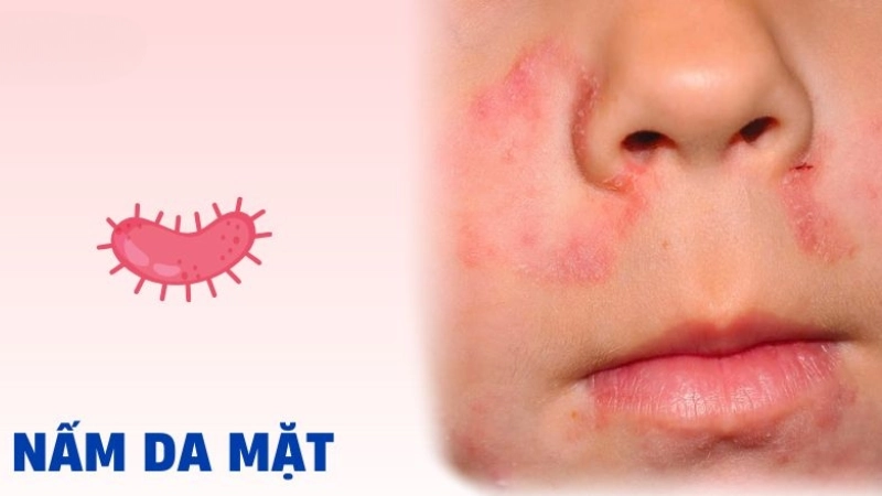 Nhận biết bệnh qua hình ảnh bệnh nấm da mặt thực tế