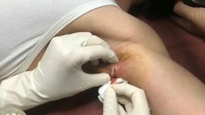 Gợi ý mẹo nhanh với cách trị mụn ổ gà ở nách tiện lợi