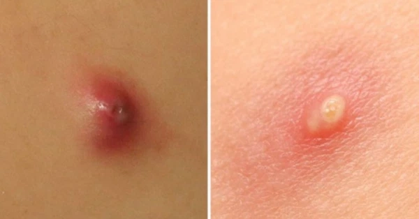 Tổng hợp hình ảnh bệnh ổ gà ở nách giúp nhận biết chính xác