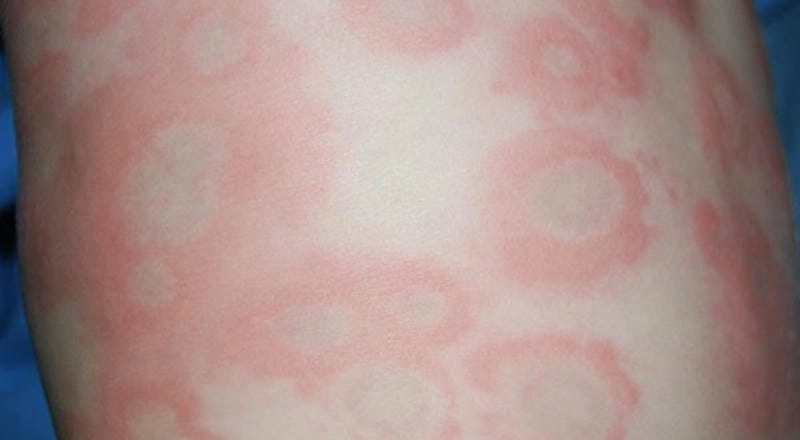 Triệu chứng thường gặp của bệnh phong ngứa