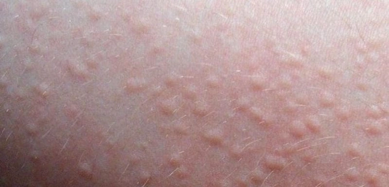 Tình trạng da khi bị bệnh phong ngứa kéo dài