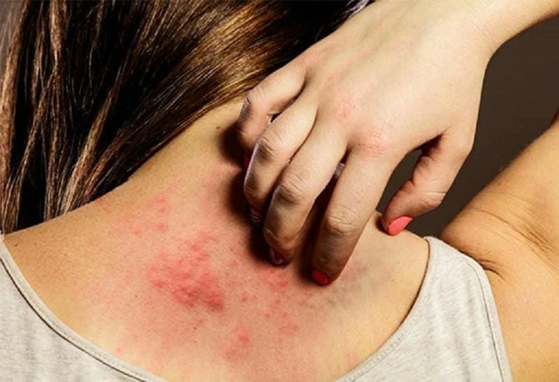 Nguyên nhân khiến bệnh phong ngứa kéo dài