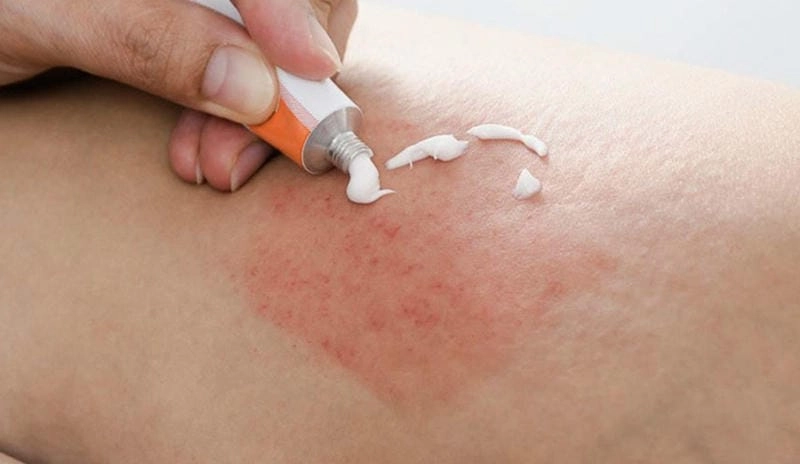 Dấu hiệu cảnh báo triệu chứng bệnh phong ngứa