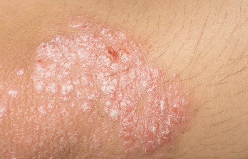 Tham khảo hình ảnh phong ngứa ở người lớn chính xác