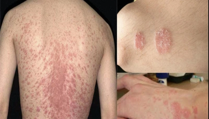 Hình ảnh bệnh phong ngứa rõ nét dễ nhận biết