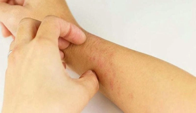 Phân biệt qua hình ảnh bệnh phong cụ thể