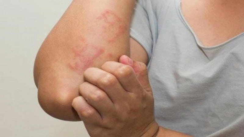 Nguyên nhân khiến bạn bị phong ngứa bất ngờ