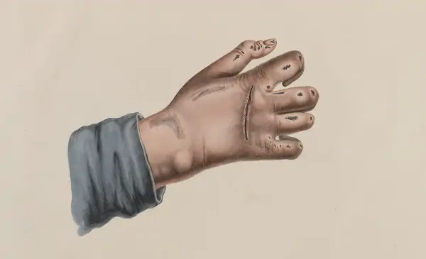 Sự nguy hiểm của phong cùi qua hình ảnh