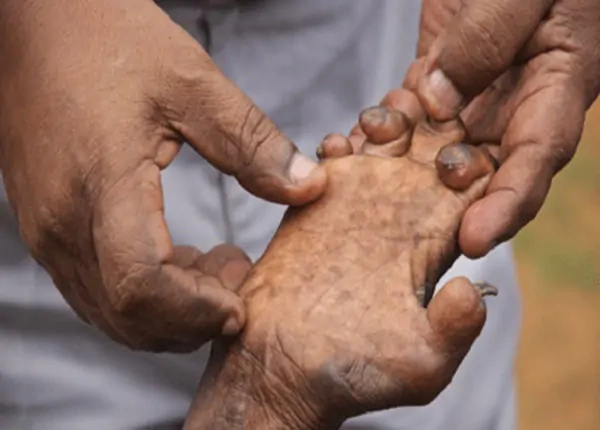 Cập nhật ảnh người bị phong cùi mới nhất