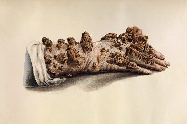 Tìm hiểu nguyên nhân bệnh phong cùi chính xác