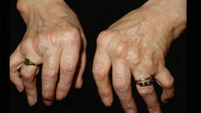 Hình ảnh rõ nét về bênh phong hủi