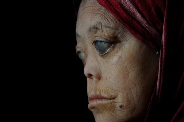 Khám phá phong cùi triệu chứng đầy đủ nhất