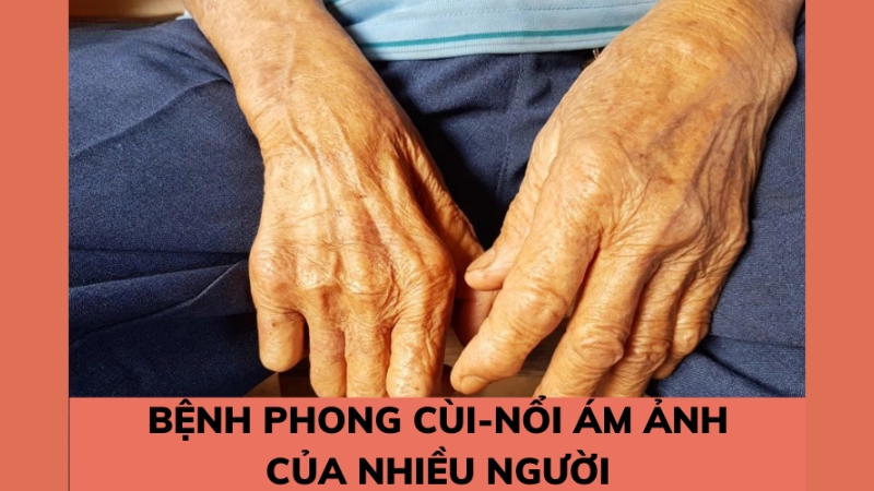 Tổng hợp hình ảnh bệnh phong cùi ở giai đoạn đầu rõ nét