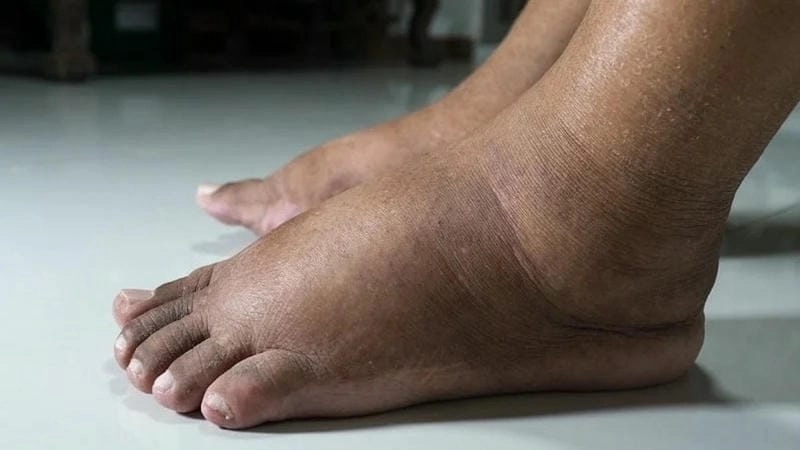 Khám phá ngay bộ ảnh phù chân voi hiếm gặp và chân thực