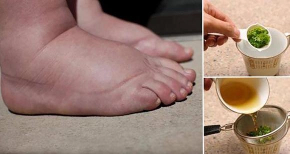 Chia sẻ hình ảnh phù chân voi thực tế từ ca lâm sàng